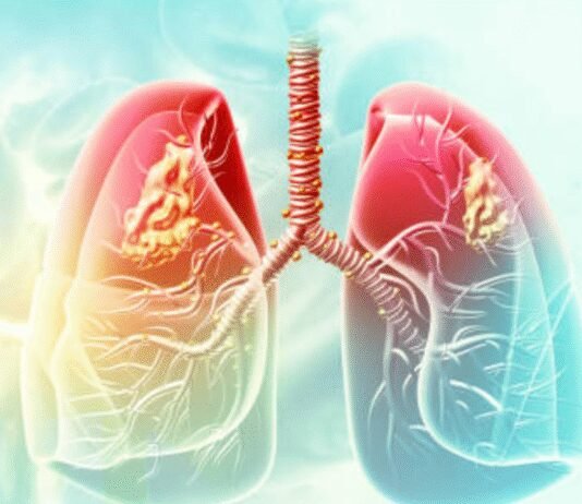 AIIMS-Delhi to study link between lung cancer and air pollution | India News
