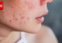 Why your acne scars won’t go away — science finds the real reason | India News