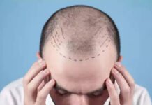 Days after TN order, doctors seek similar rules nationwide as hair transplant boom raises safety alarm | India News